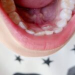 舌下免疫療法